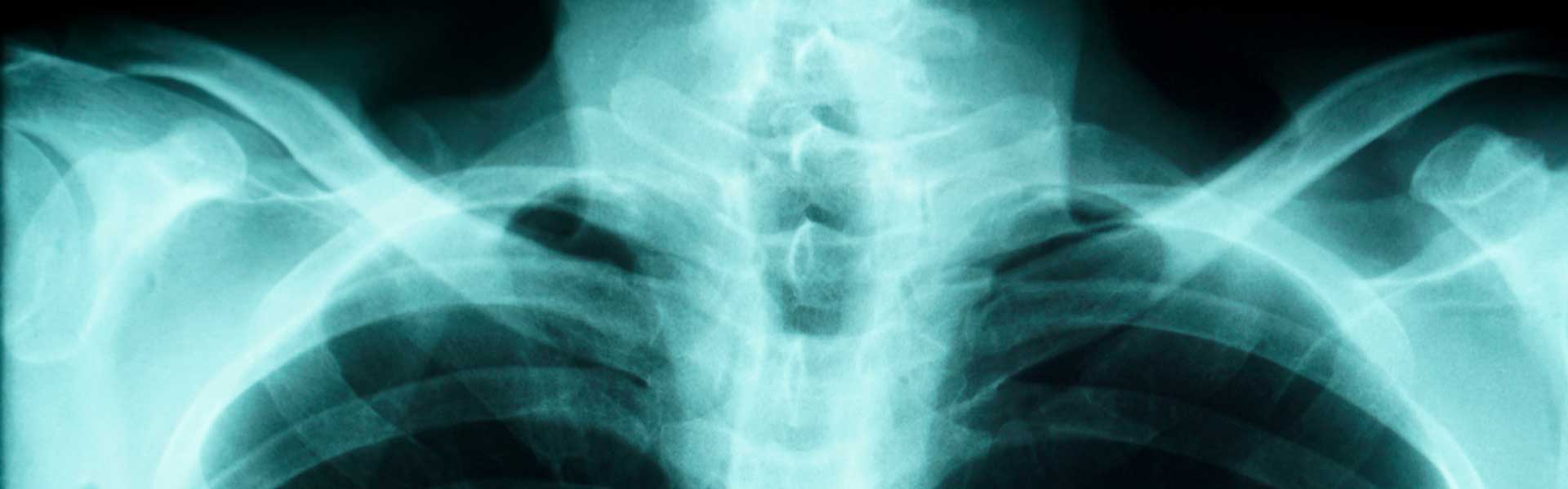 X-ray of upper chest