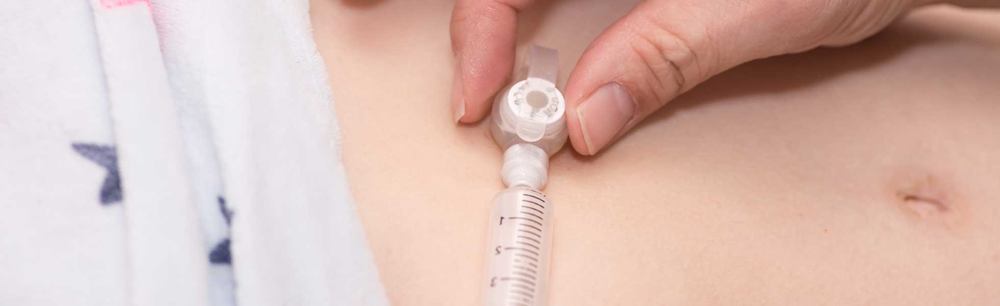 Stomach with feeding tube